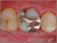 cerec Masek_before.jpg